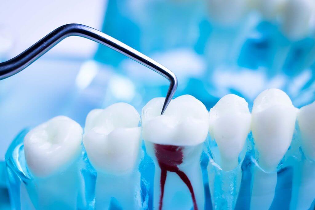 dental root canals in southampton